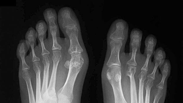 Nanovedades: nuevos tratamientos para la artritis reumatoide